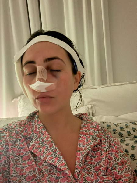 bandages nose split and ear protector one day after a revision rhinoplasty